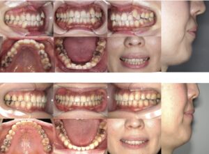 インビザラインによる矯正歯科治療例３