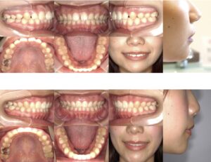 インビザラインによる矯正歯科治療例２