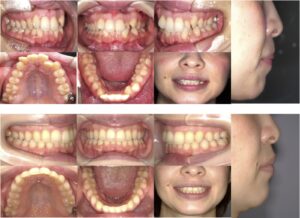 インビザラインによる矯正歯科治療例１