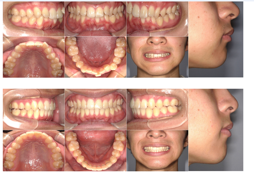 矯正治療　費用と期間、そして仕上がりも満足いただけました。