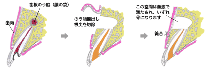 歯根端切除