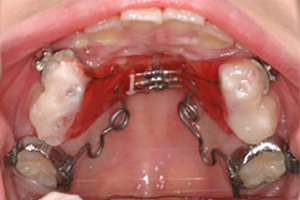 奥歯の遠心移動 治療の様子