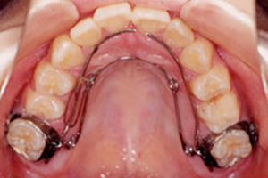 歯列弓拡大の装置