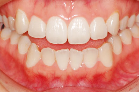 北九州市小倉北区の矯正歯科｜開咬（オープンバイト）の矯正治療なら