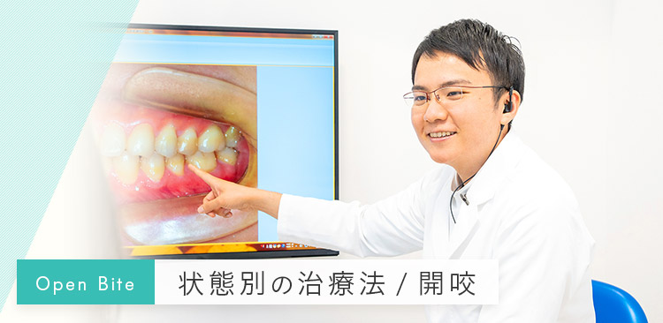 北九州市小倉北区の矯正歯科｜開咬（オープンバイト）の矯正治療なら