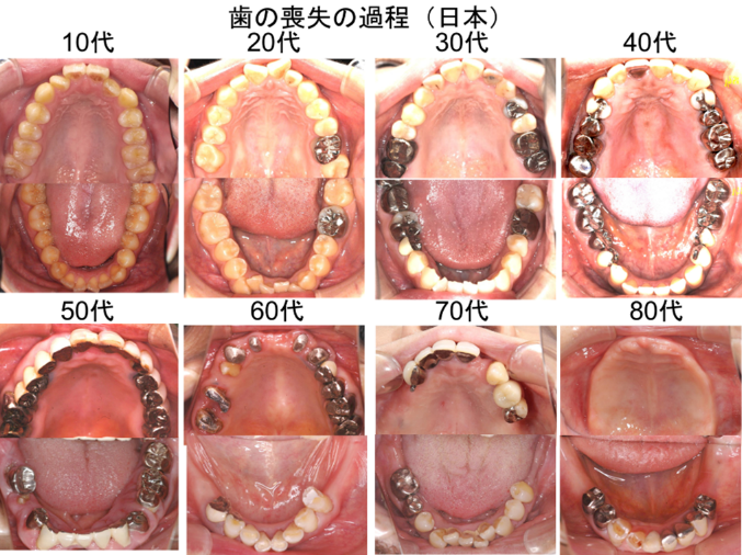 歯の喪失の過程（日本）