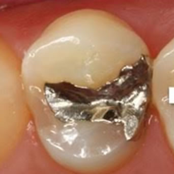 保険虫歯再発_1-1