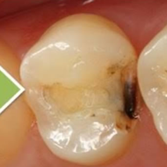 保険虫歯再発_1-2
