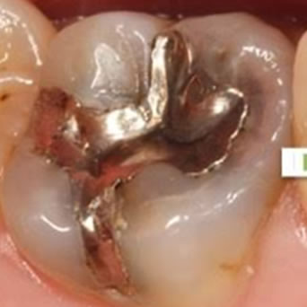 保険虫歯再発_2-1