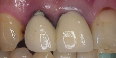 保険虫歯再発_4-1