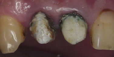 保険虫歯再発_4-2