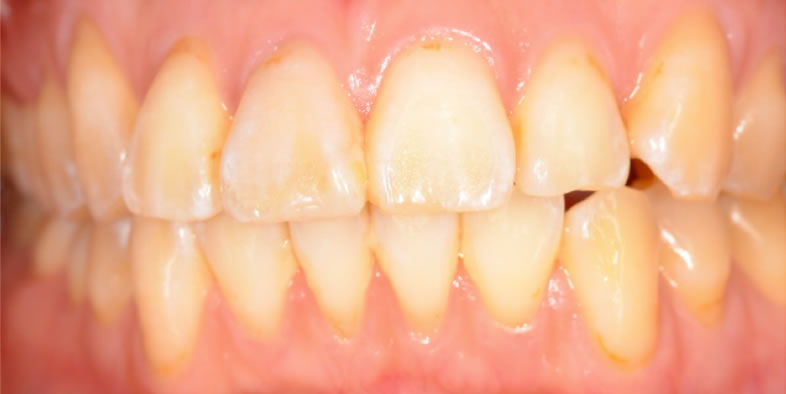 ホワイトニング症例_3_1